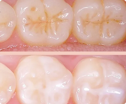 Dental Sealants at Northern New Mexico Dental Center