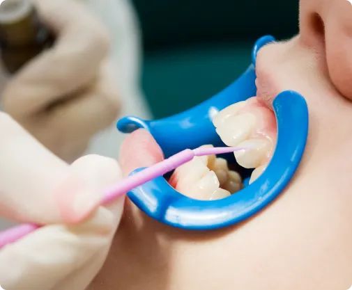Fluoride Treatment at Northern New Mexico Dental Center