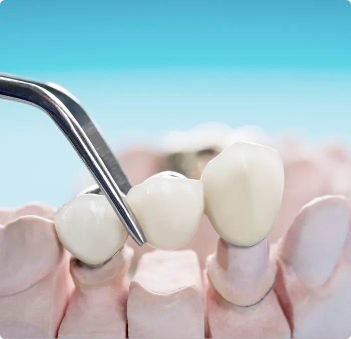 Dental Bridges at Northern New Mexico Dental Center