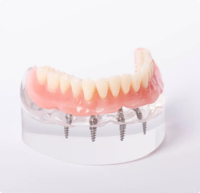 Implant-Supported Dentures at Northern New Mexico Dental Center