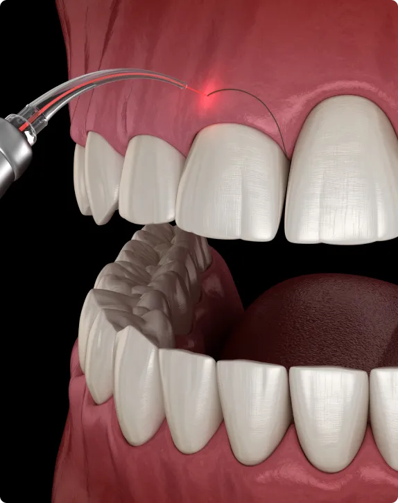 Laser Gum Treatment at Northern New Mexico Dental Center