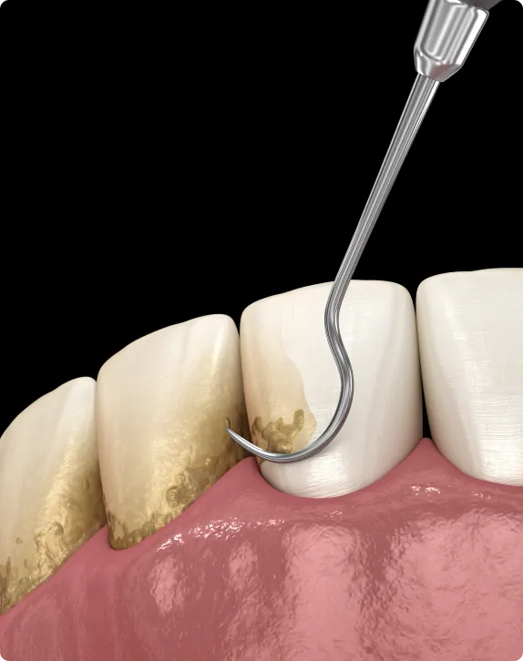 Scaling & Root Planing at Northern New Mexico Dental Center
