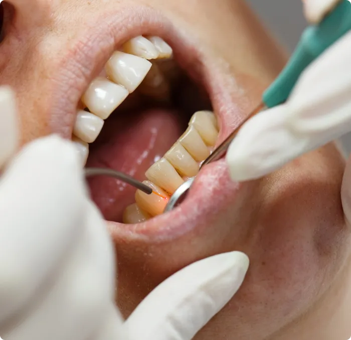 Soft Tissue Laser at Northern New Mexico Dental Center