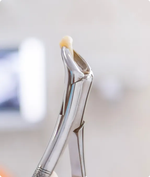 Tooth Extractions at Northern New Mexico Dental Center